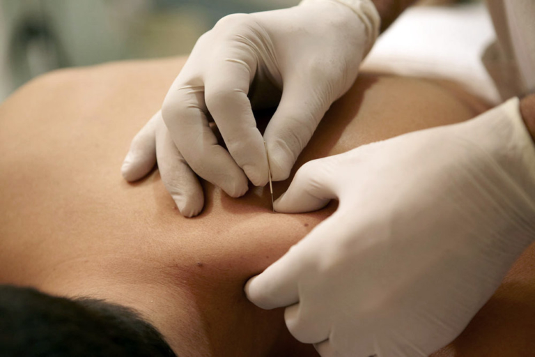 Dry Needling — puncture sèche pratiquée par un kinésithérapeute